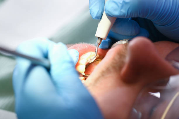 Best Emergency Treatment for Dental Infections or Abscesses in Golden Glades, FL