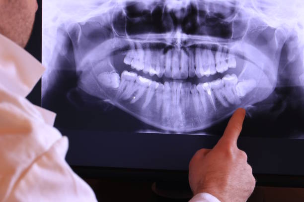 Best Emergency Root Canal Treatment in Golden Glades, FL